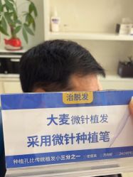 -大麦微针植发丨全国连锁