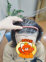 -大麦微针植发全国连锁