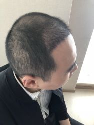 点击看大图 -大麦微针植发丨全国连锁