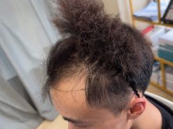 -碧莲盛·不剃发植发