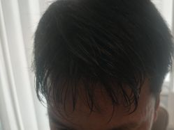 -碧莲盛·不剃发植发