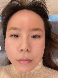 体验后-亿美医疗美容·半岛大超炮官方授权店