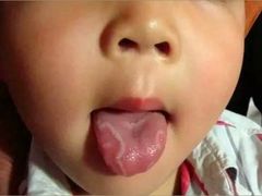 偏食挑食～地图舌-海南现代妇女儿童医院(府城院区)