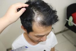 -大麦微针植发丨全国连锁