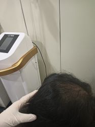 -碧莲盛·不剃发植发
