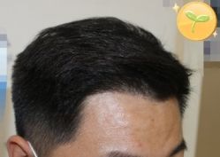 -大麦微针植发丨全国连锁