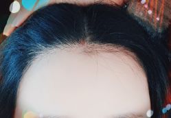 -大麦微针植发全国连锁