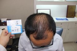 体验前-大麦微针植发全国连锁