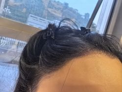 -碧莲盛·不剃发植发