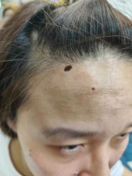 -北京美痣堂古方祛痣斑疣瘊