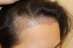 -大麦微针植发全国连锁