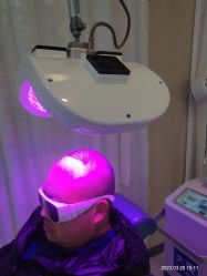 体验后-大麦微针植发丨全国连锁