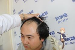 点击看大图 -大麦微针植发丨全国连锁