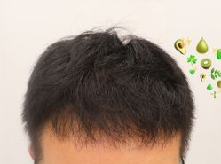 -大麦微针植发全国连锁