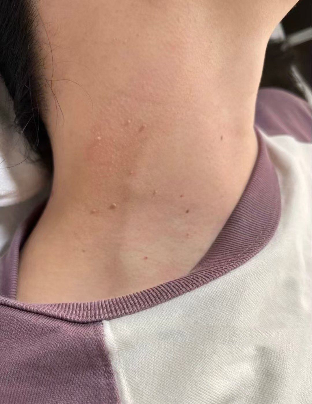 💙长扁平疣丝状疣🚫戴项链🚫搓澡
反复摩擦会窜的满脖子都是