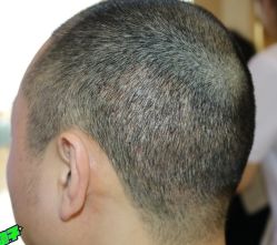 -大麦微针植发丨全国连锁