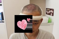 -大麦微针植发丨全国连锁