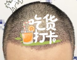 -大麦微针植发全国连锁