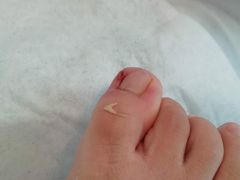 -世龙世家灰指甲鸡眼脚气甲沟炎跖疣护理(通州店)