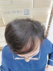 -大麦微针植发丨全国连锁