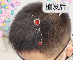 -大麦微针植发全国连锁