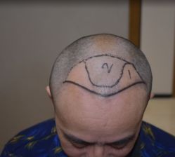 -大麦微针植发全国连锁