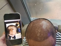 -碧莲盛·不剃发植发