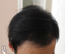 -大麦微针植发丨全国连锁