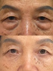 点击看大图 -广州健丽·去眼袋医疗美容机构