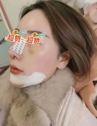 体验后-郡艺医疗美容·微整·眼鼻吸脂