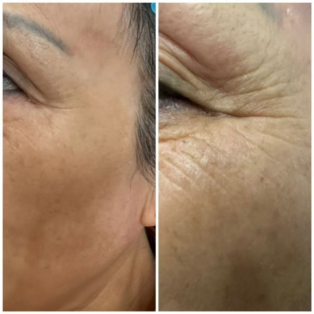 长皱纹用什么方法去除百科在线 长皱纹用什么方法去除百科在线