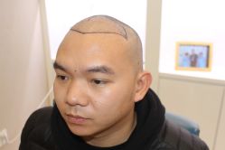 点击看大图 -大麦微针植发丨全国连锁