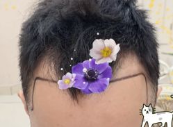 -大麦微针植发全国连锁
