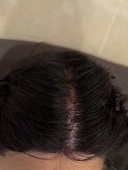 -碧莲盛·不剃发植发