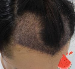 -大麦微针植发丨全国连锁