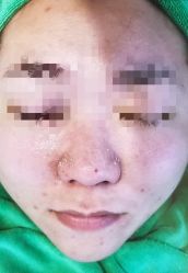 -苗方清颜·祛痘皮肤管理