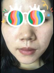 -爱莎扁平疣·汗管瘤·斑痣中心