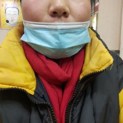 体验后-北京美痣堂古方祛痣斑疣瘊