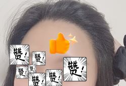 -大麦微针植发全国连锁