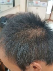 -碧莲盛·不剃发植发