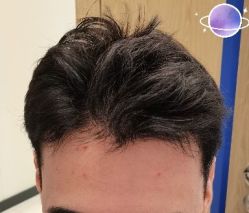 -大麦微针植发丨全国连锁