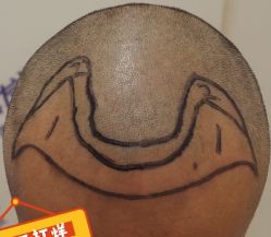 -大麦微针植发全国连锁