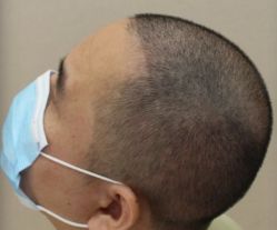 -大麦微针植发丨全国连锁