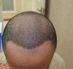 -大麦微针植发丨全国连锁