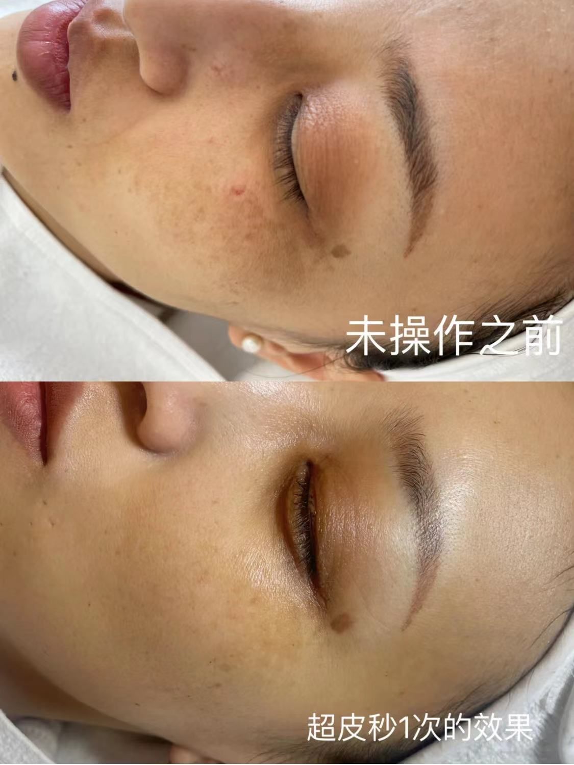 美国赛诺秀 #蜂巢皮秒
适应症:雀斑