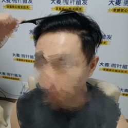 -大麦微针植发丨全国连锁