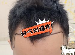 -大麦微针植发全国连锁