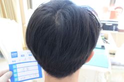 -大麦微针植发丨全国连锁