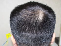 -大麦微针植发丨全国连锁