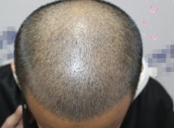 -大麦微针植发丨全国连锁